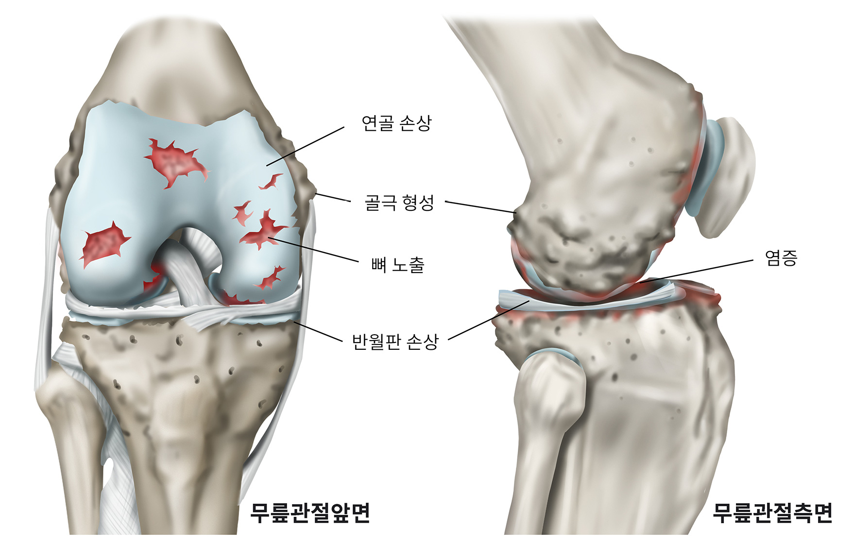 무릎퇴행성관절염