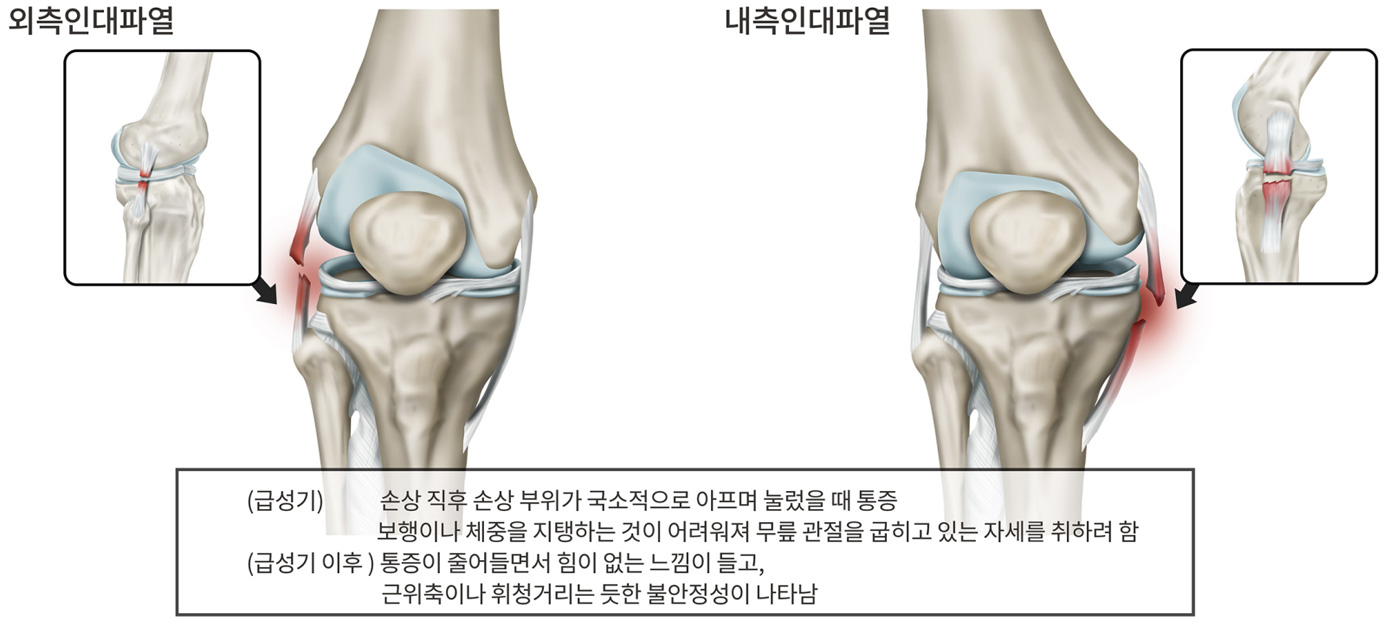무릎측부인대파열
