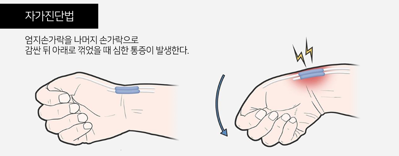 손목건초염 자가진단법